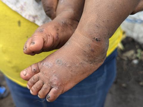 Foot of a baby with Mpox